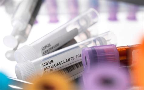lupus blood test results|Diagnosing and Treating Lupus .